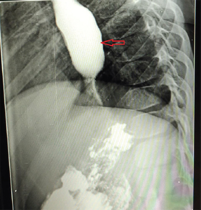 Arrow in the Barium swallow X-ray showing a prominent bird beak sign, oesophageal dilatation and incomplete relaxation of the lower oesophageal sphincter.